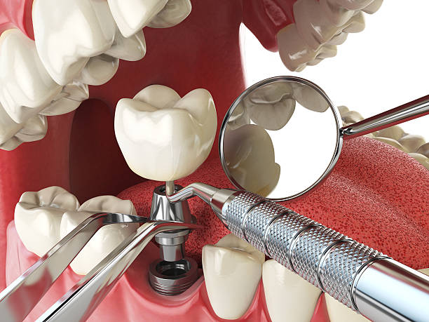 Best Emergency Wisdom Teeth Removal in Coshocton, OH